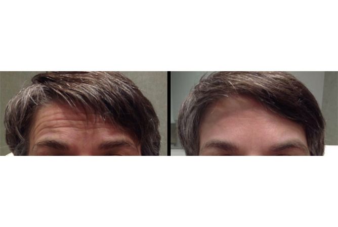 Forehead before and after treatment, showing fewer wrinkles.