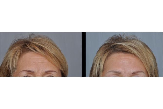 Comparison of a woman's forehead before and after a procedure to reduce forehead wrinkles.