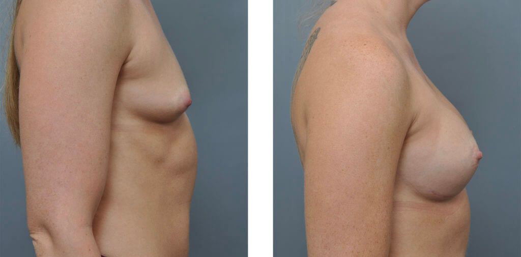 Two side-view photos: before and after breast augmentation.