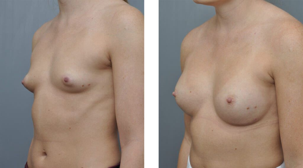 Before and after comparison of a person's chest after a breast augmentation procedure.
