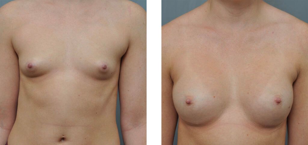 Before and after view of breasts, the after on the right showing augmented size.