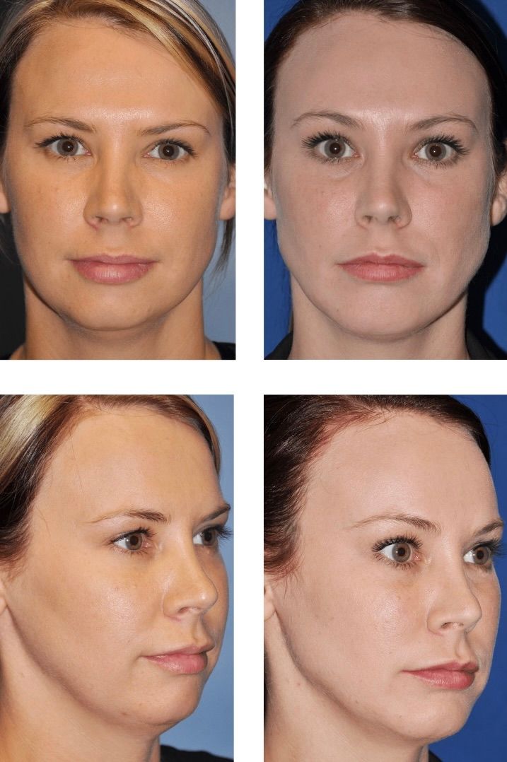 Side-by-side comparison of a person's face. Before and after photos show subtle changes in facial structure.