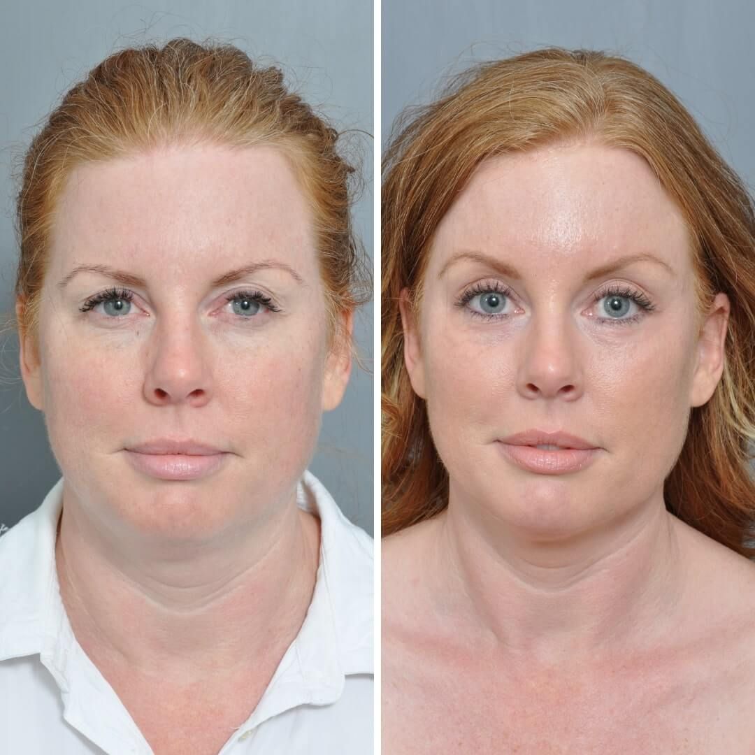 Side-by-side comparison. Woman's face with less wrinkles and softer features on the right. Both photos show fair skin and red hair.