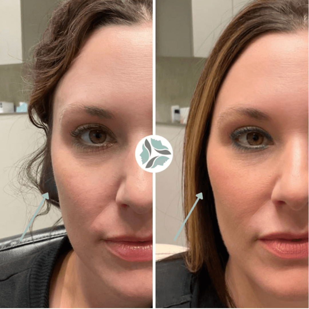 Split face comparison: Before and after cheek filler. Right side shows enhanced cheekbones, full.