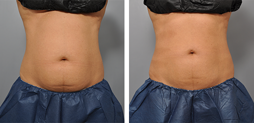 Side-by-side comparison of a person's abdomen, before and after a procedure. The 