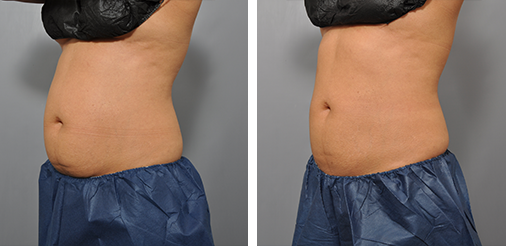 Side-by-side comparison of a person's abdomen, showing a reduction in fat after a procedure.