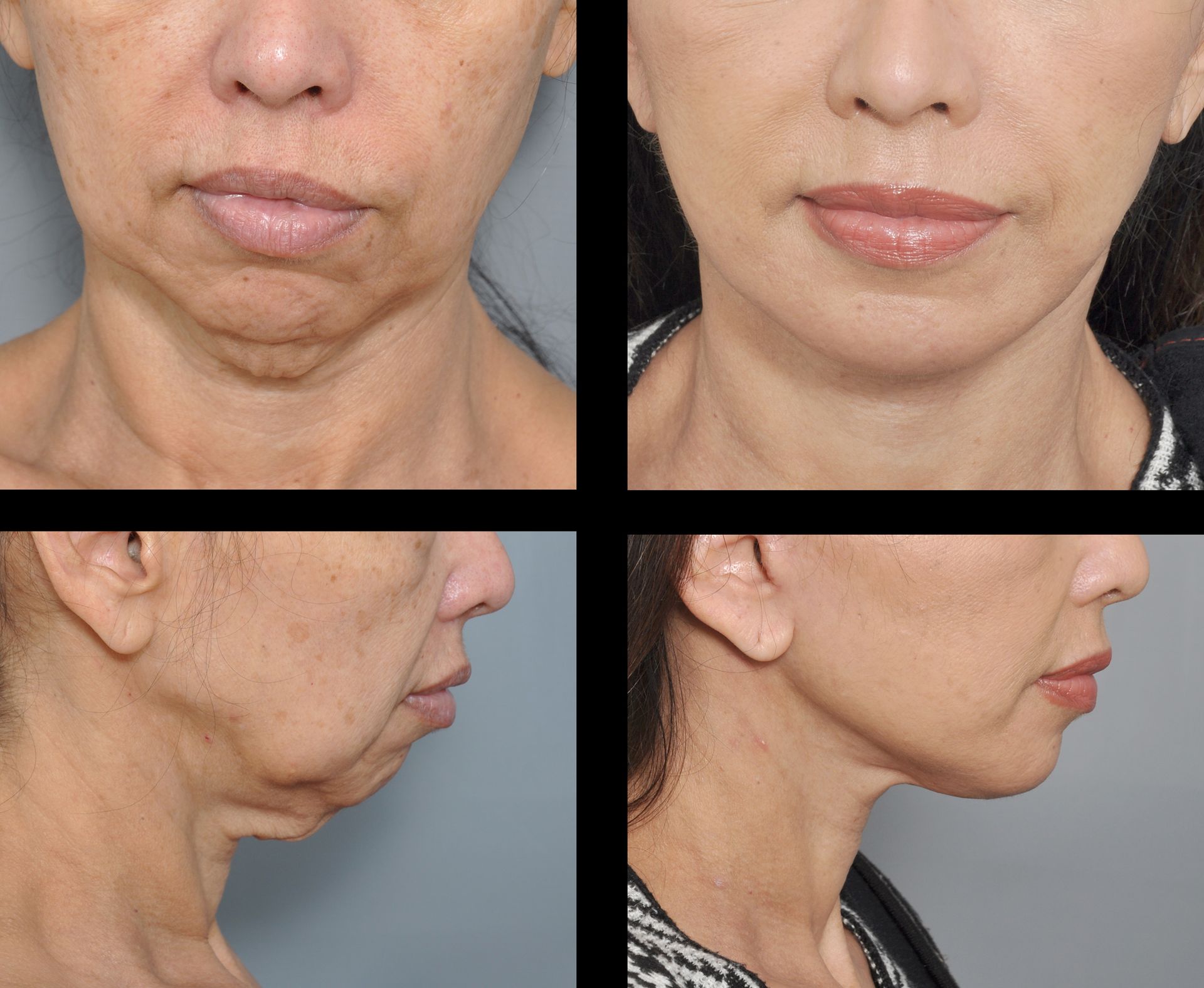 before and after chin implant and facelift 
