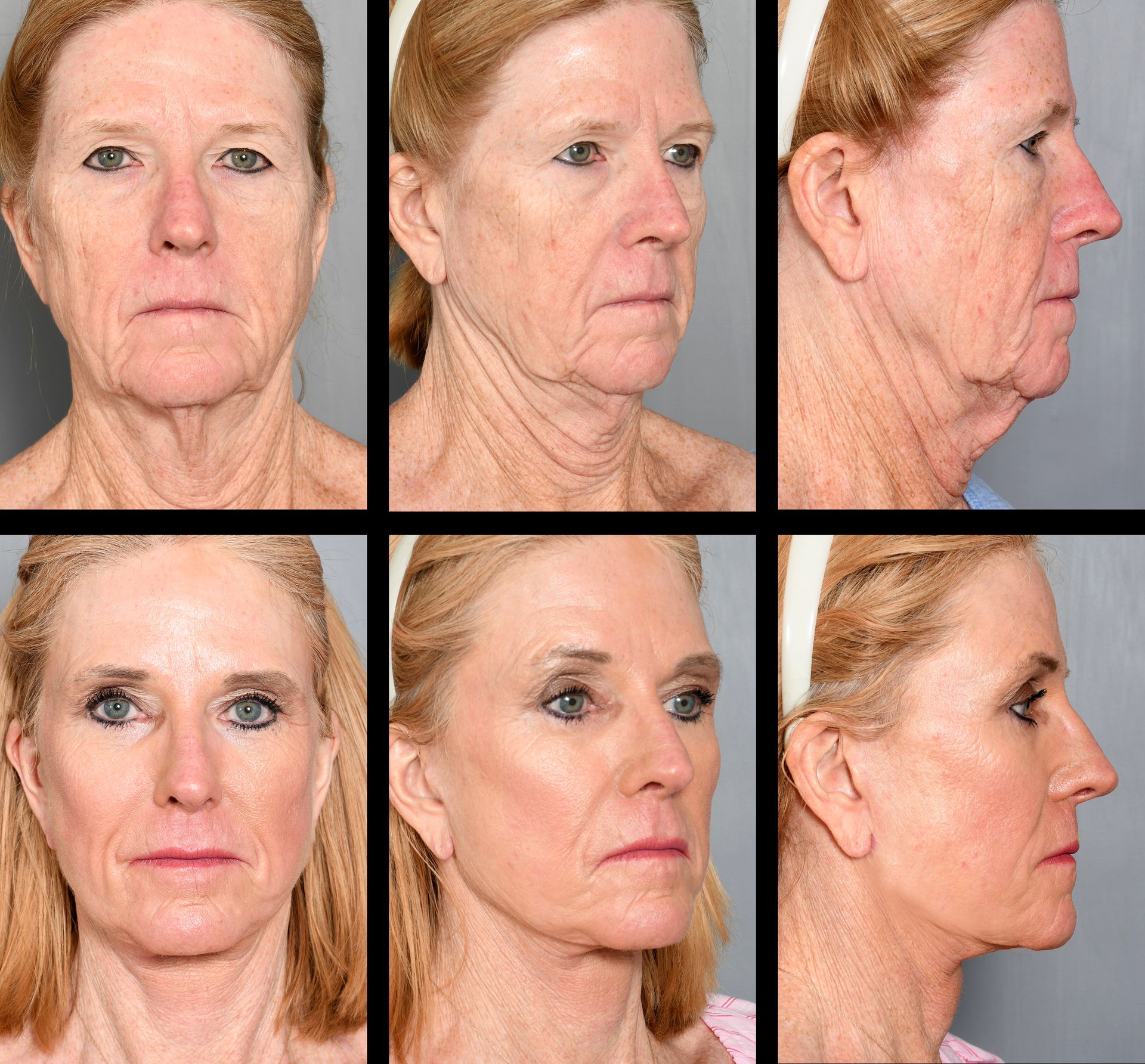 before and after deep plane facelift in baton rouge
