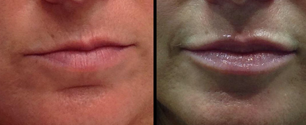 Before and after photos of lips; lips appear fuller and more moisturized in the right photo.
