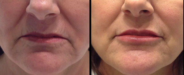 Before and after comparison of lips; wrinkles reduced, lips fuller and smoother.
