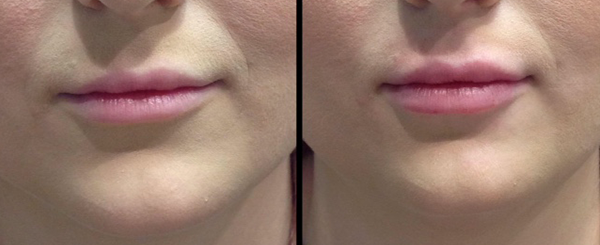 Before and after lips, showing a cosmetic procedure.