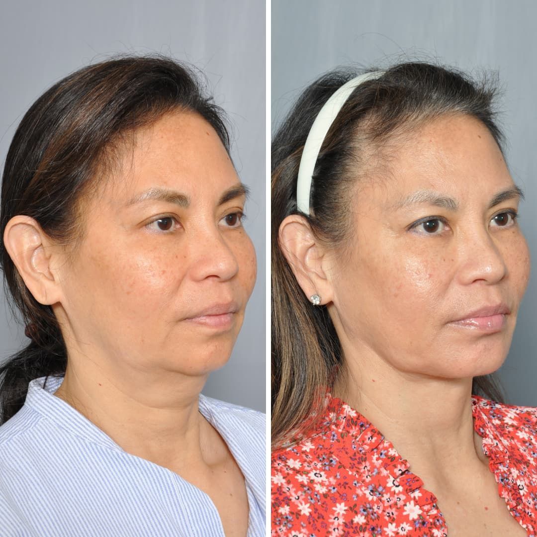 Side-by-side photos of a person's face. Left side shows before, right shows a slightly tightened appearance.