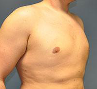 Bare-chested person; side view of torso; skin is light-toned; chest shows a prominent nipple.