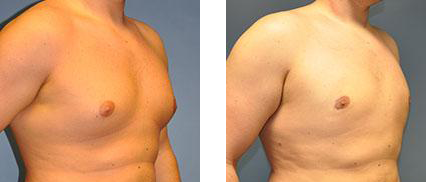 Two side-by-side views of a male torso. The right view shows a flatter chest compared to the left.
