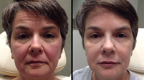 Before and after photo of a woman's face, showing reduction in wrinkles and improved skin tone.
