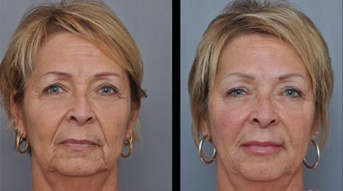 Side-by-side comparison of a woman's face before and after a cosmetic procedure, showing reduced wrinkles.
