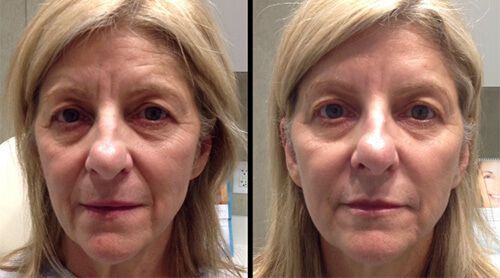 Two side-by-side images. Woman's face before and after cosmetic procedure. Smoother skin, reduced wrinkles.