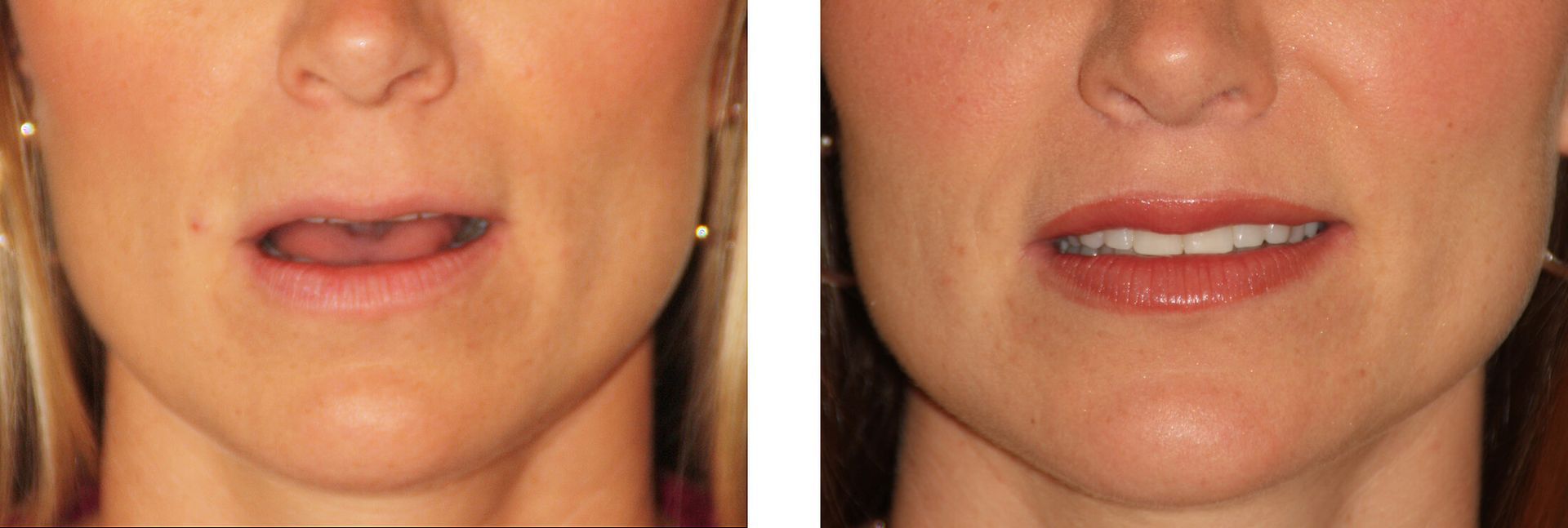 Woman's face exhibiting a droop on one side; the right side appears normal.