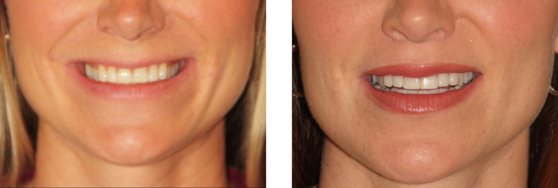 Before and after photo of a woman's mouth; the 