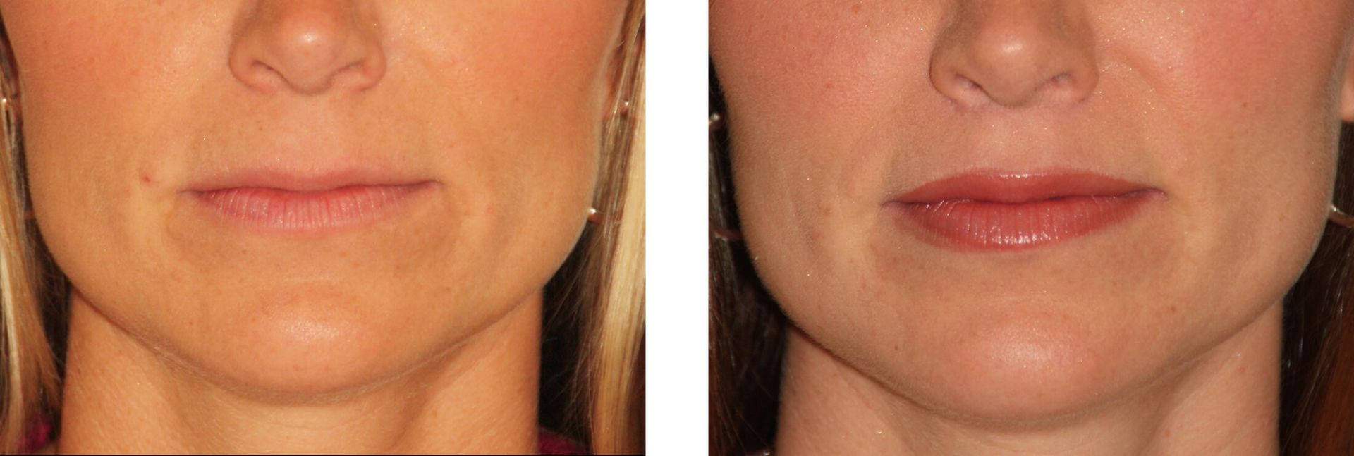 Before and after comparison of lips; the 