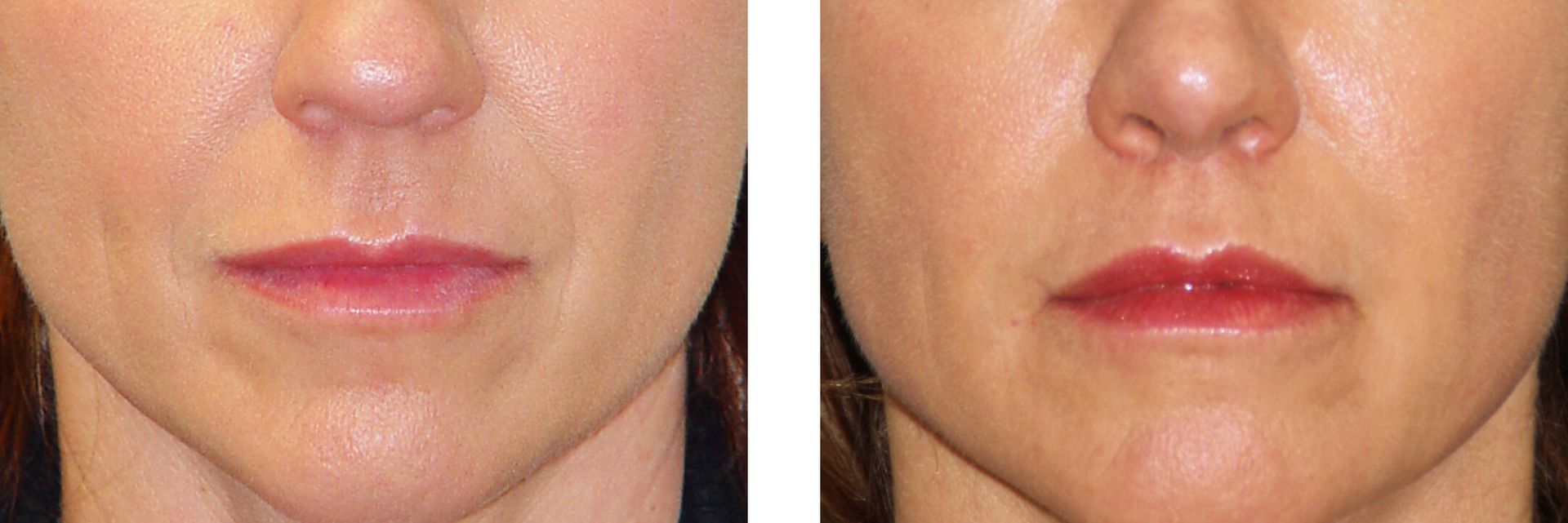 Before and after photos of a woman's lips, showing a cosmetic treatment; lips are more full and defined on the right.