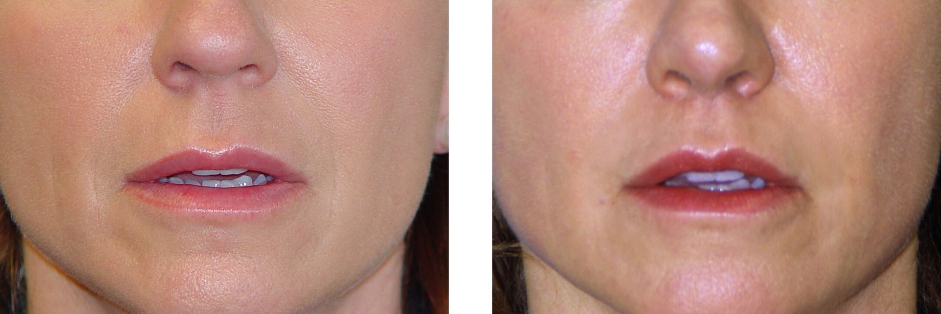 Before and after close-up of a person's mouth and nose. The lips appear fuller and pinker in the after image.