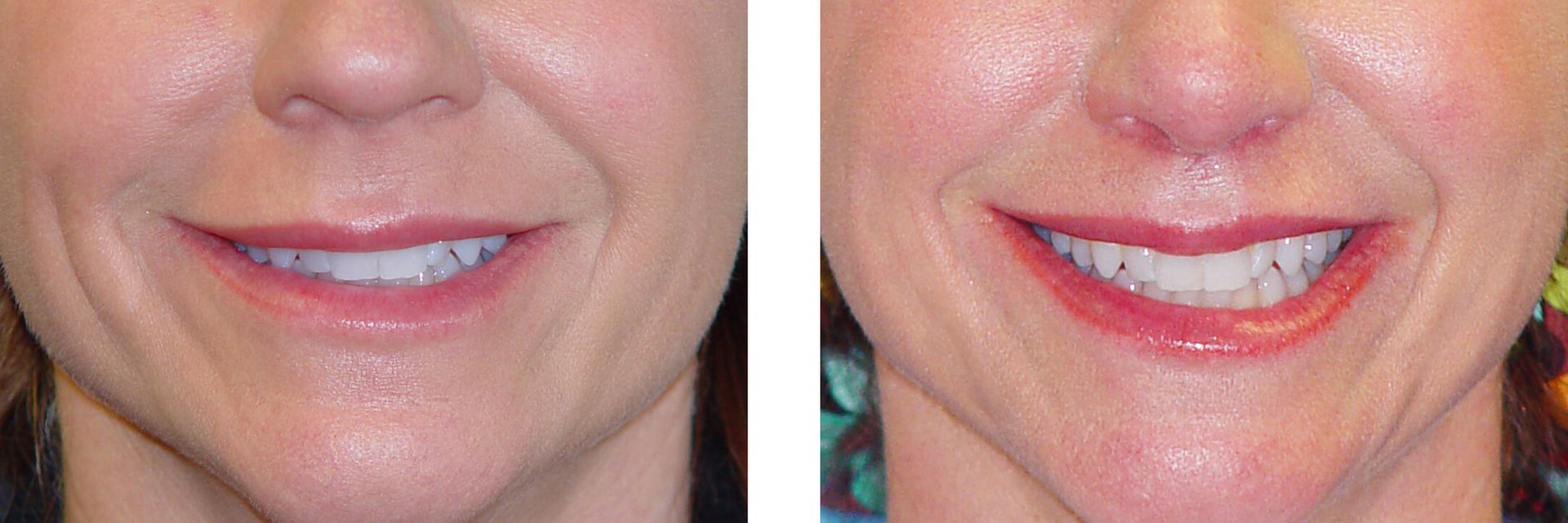 Before and after of a woman's smile, showing fuller lips and improved teeth appearance.