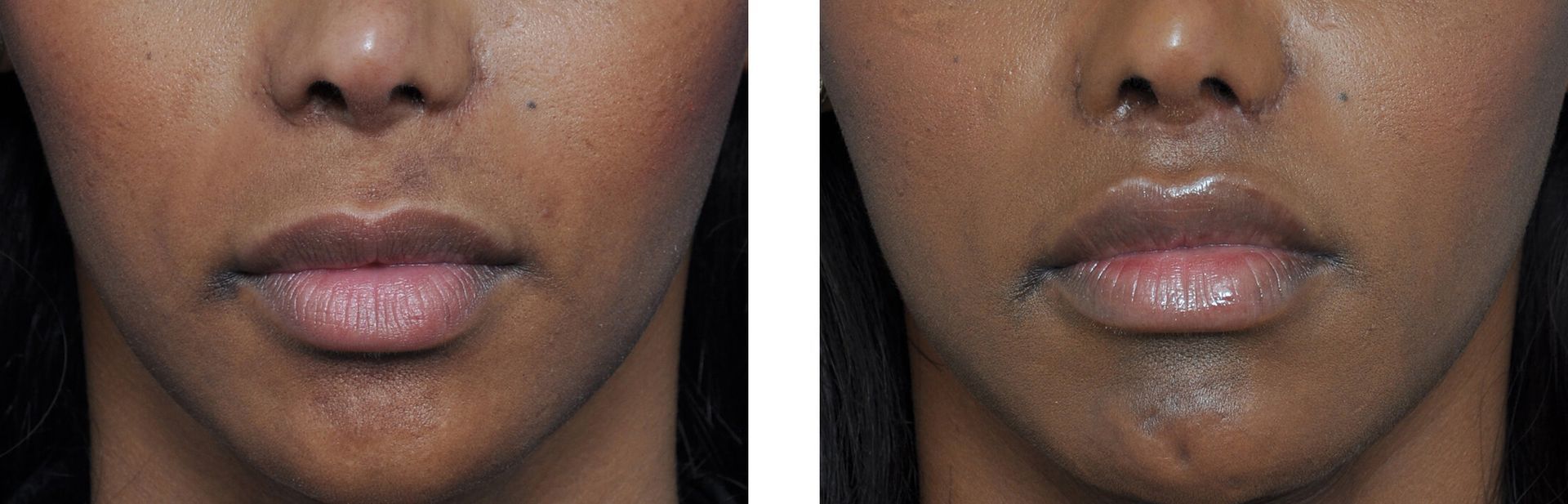 Before and after of a person's lips. The lips appear fuller in the after photo.