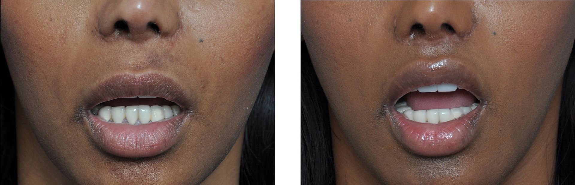 Two close-up photos of a person's mouth with a slight difference in lip appearance; before and after.