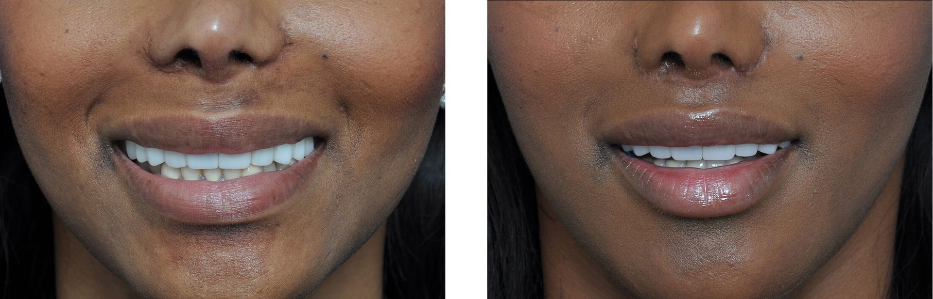 Side-by-side view of a person’s mouth before and after teeth whitening and lip enhancement.