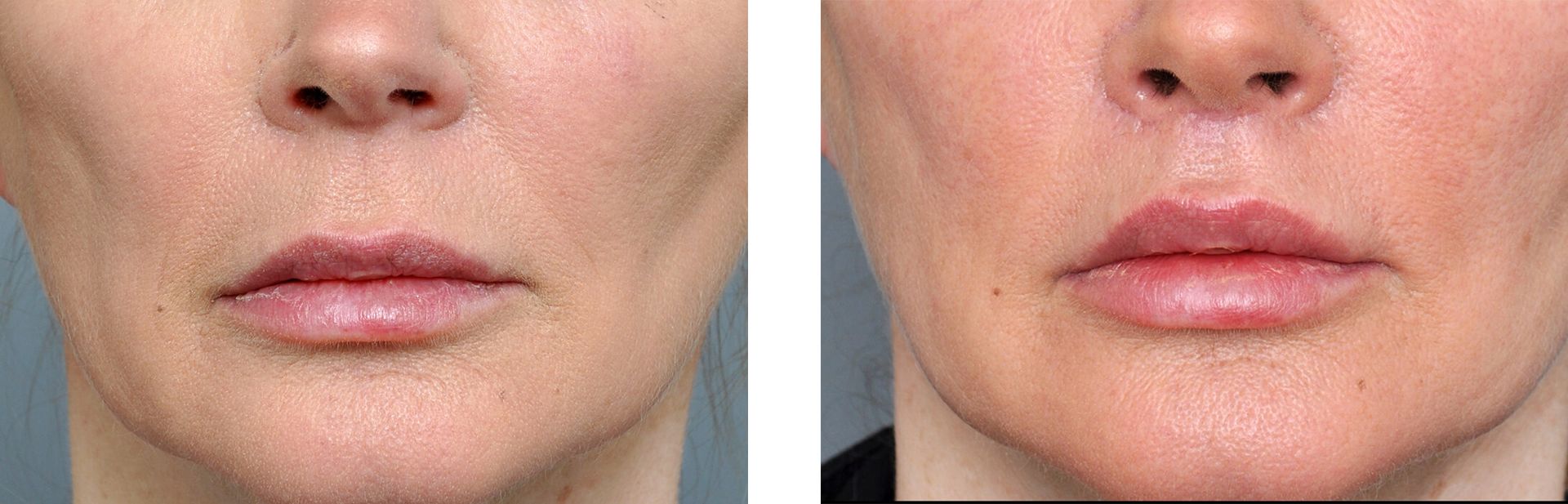 Before and after photos of a person's face. The lips are fuller and more defined in the after photo.