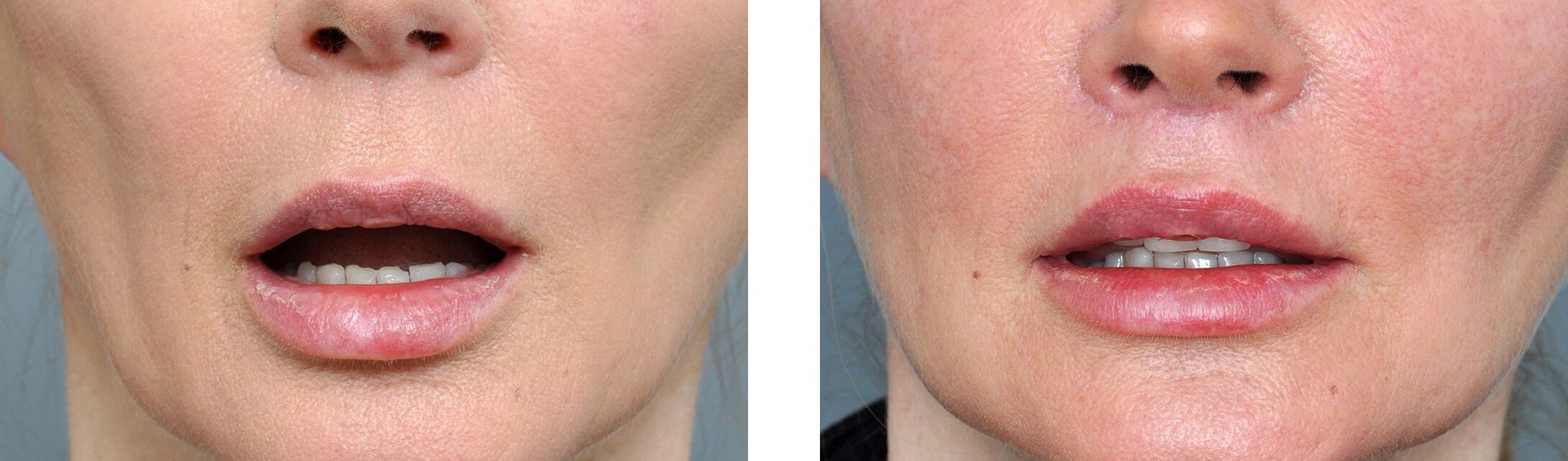Two side-by-side photos of a person's mouth and lower face, before and after lip augmentation.
