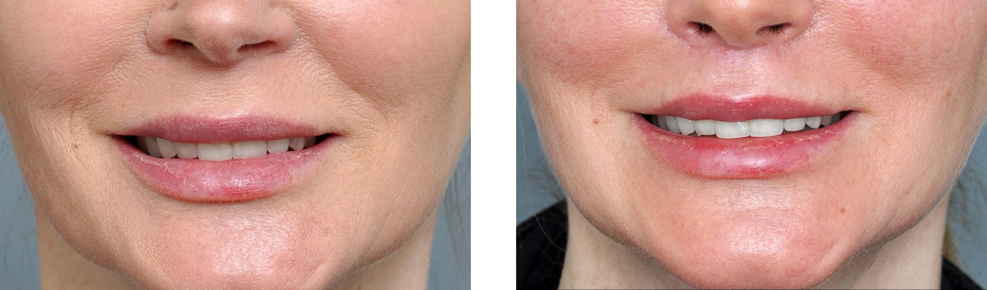 Side-by-side comparison of a person's mouth before and after a procedure, showing improved lip fullness and reduced wrinkles.