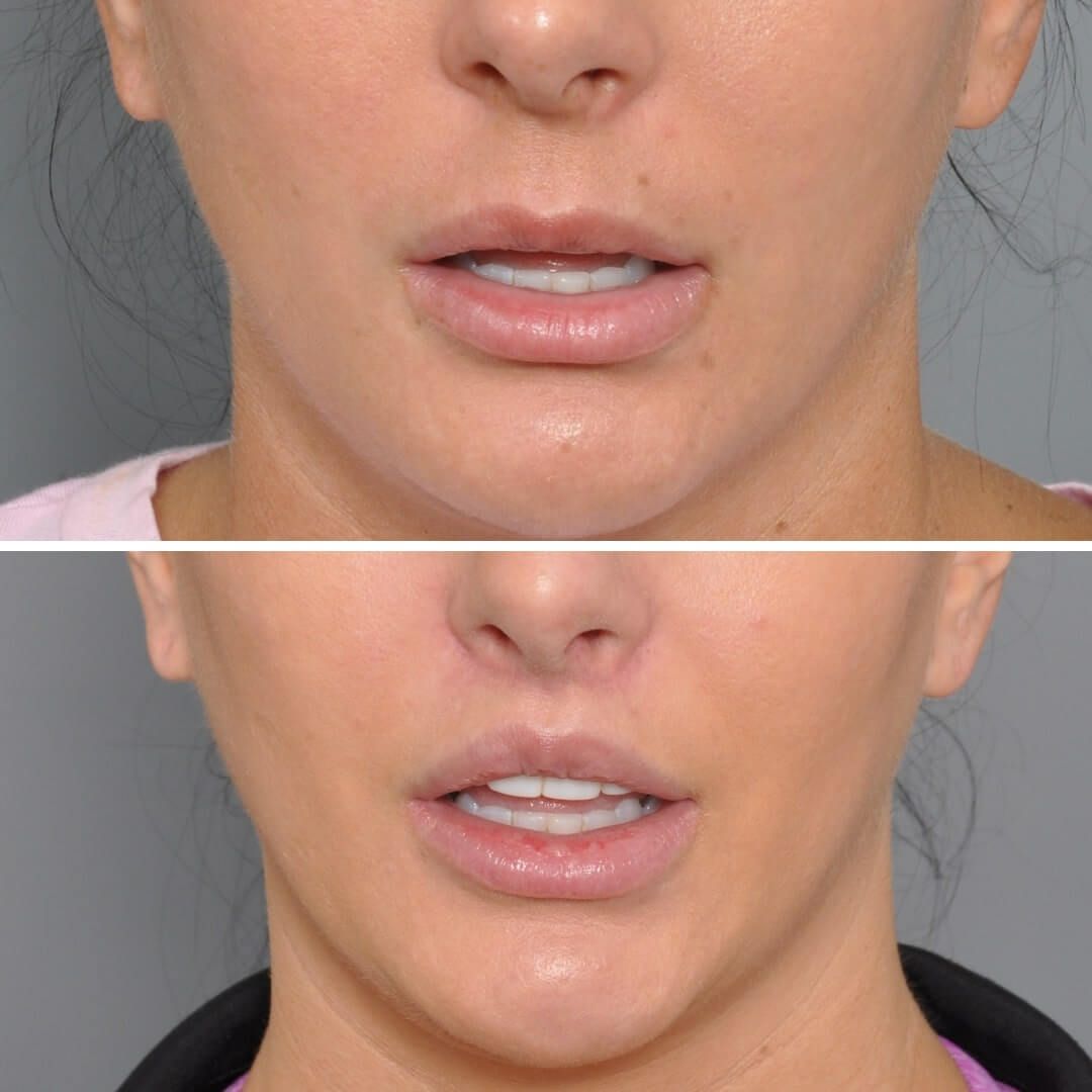 Comparison of woman's lips before (top) and after (bottom) lip filler injections, showing increased volume.