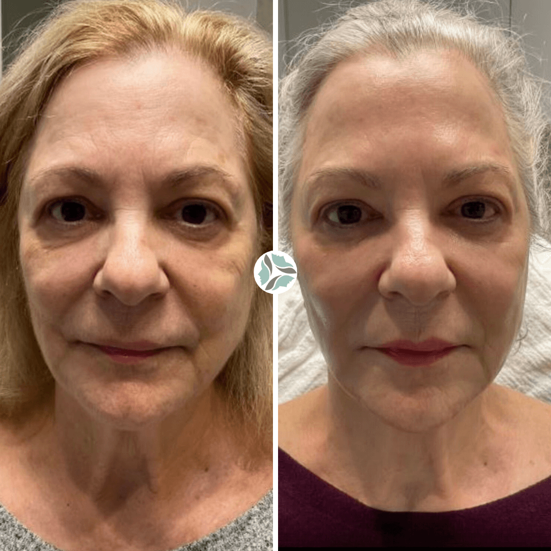 Before and after facial cosmetic procedure: older woman with smoother skin, reduced wrinkles.
