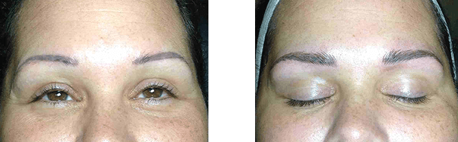 Two photos side-by-side show a person's eyes before and after an eyebrow procedure. The left has open eyes, the right has closed eyes with swelling.