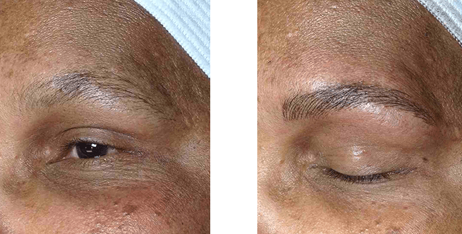 Left eye with sparse brow, right eye with fuller, darker microbladed brow.