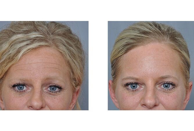 Before and after comparison of a woman's forehead, showing wrinkle reduction.
