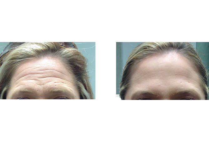 Forehead comparison: Before and after, showing wrinkles smoothed out.