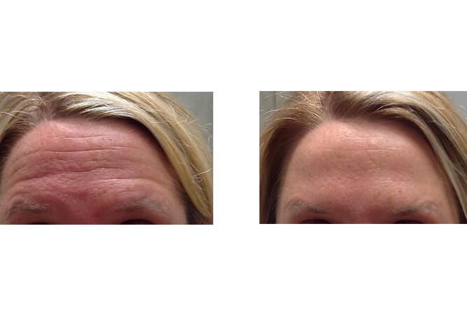Forehead before and after treatment, showing reduction in wrinkles.