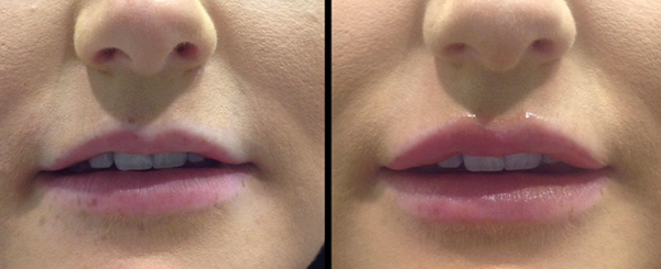 Comparison of lips before and after a procedure. The after photo shows fuller, pink lips.