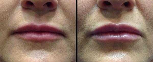 Comparison of two lip images, one before and after lip filler treatment, showing fuller lips.