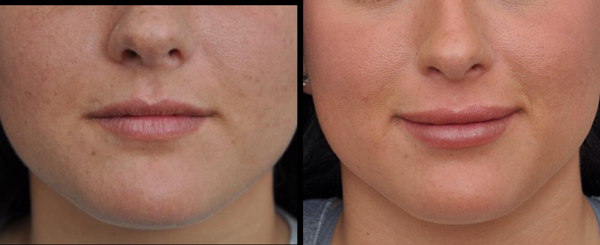 Comparison of a woman's lips before and after a lip augmentation procedure.