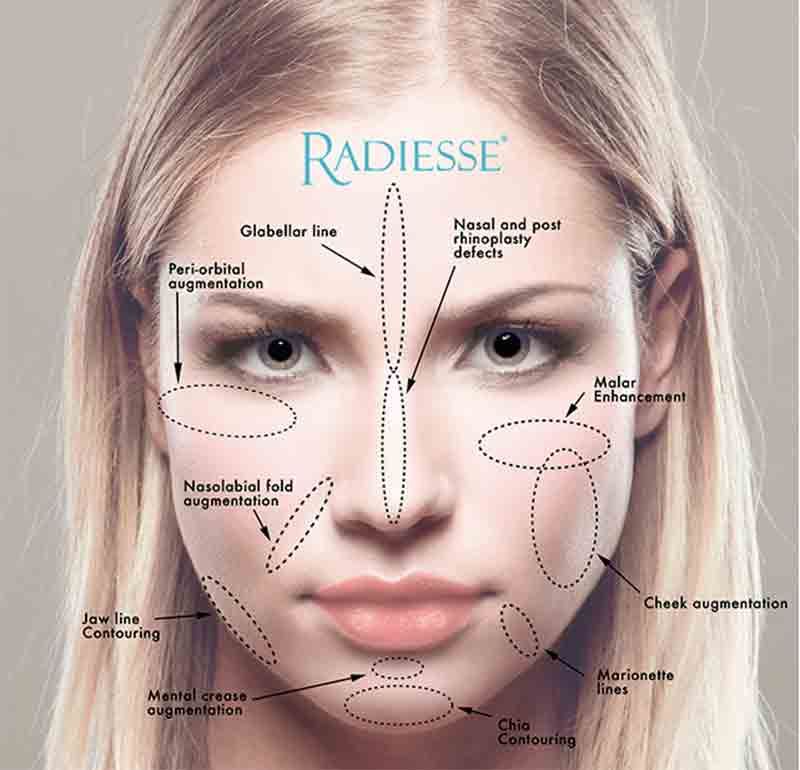 Diagram of a woman's face with dotted lines indicating areas for Radiesse filler treatments.