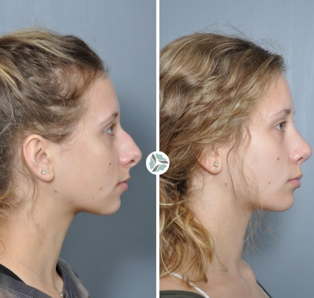 Before and after profile views of a person's nose following rhinoplasty. The bridge is straighter, tip more refined.