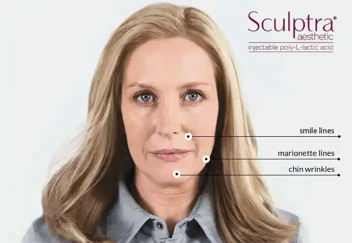 Woman with facial lines labeled for Sculptra treatment: smile, marionette, chin.