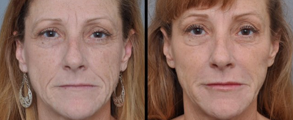 Side-by-side view of a woman's face, before and after a cosmetic procedure, showing a reduction in wrinkles.