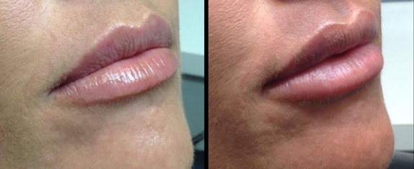 Two side-by-side closeups of lips: Before and after, with a difference in size and fullness.