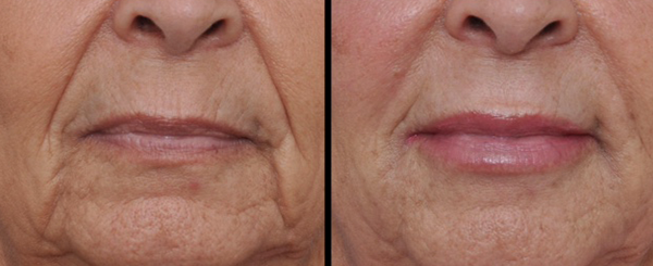 Before-and-after of a person's lips. The lips appear fuller and less wrinkled in the 