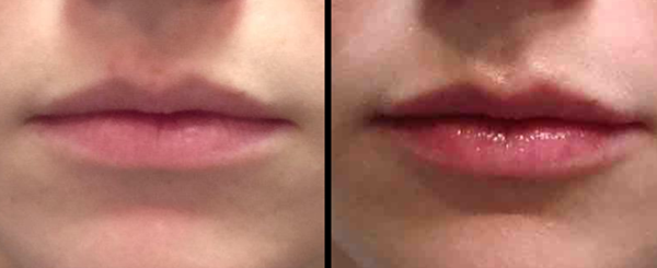 Two close-up images of a person's lips. The lips on the right appear fuller and glossier.